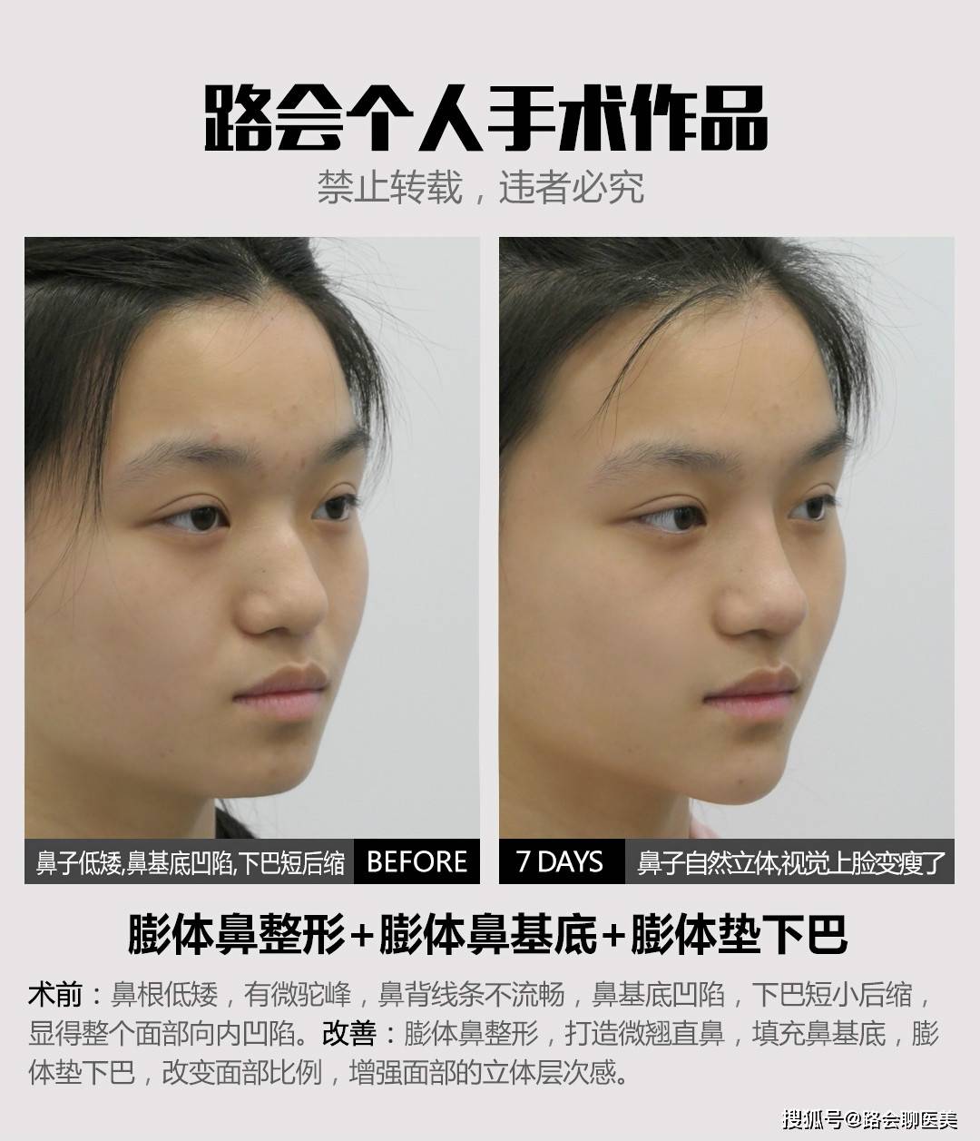 个人|鼻整形手术,到底是局麻好?还是全麻好?