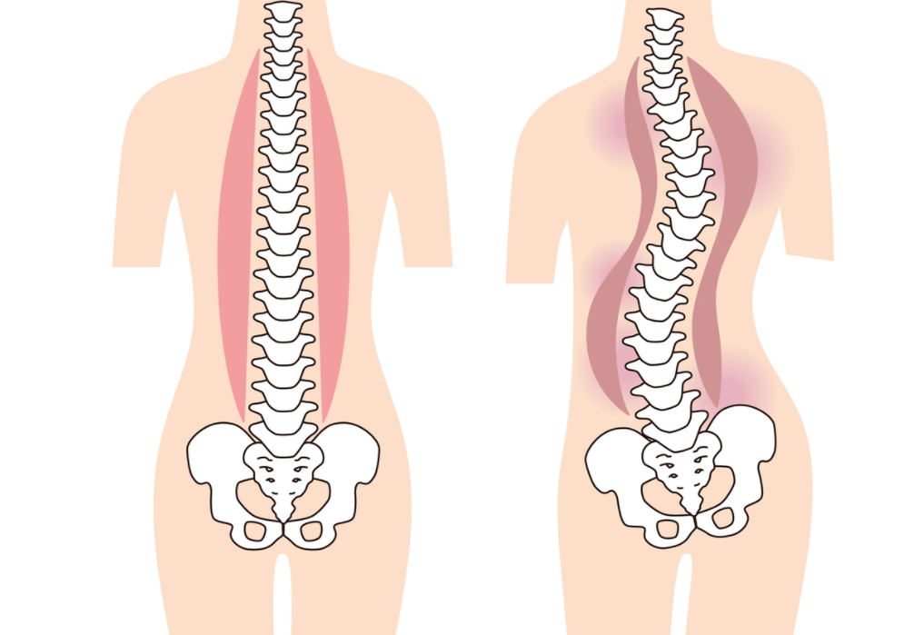 優益優高考補習學校 成長殺手 脊柱側彎 如何一步步摧毀孩子的身體 姿勢 中國熱點