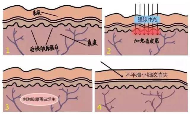 王艳|王艳医生美容科普：光子嫩肤适应症？