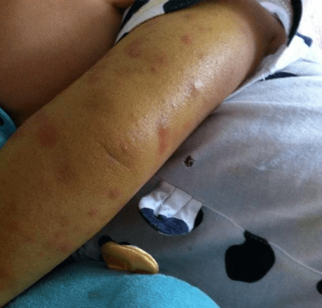 除虫菊|触目惊心！蚊子传染19006例登革热，秋季严防这种“毒蚊”！