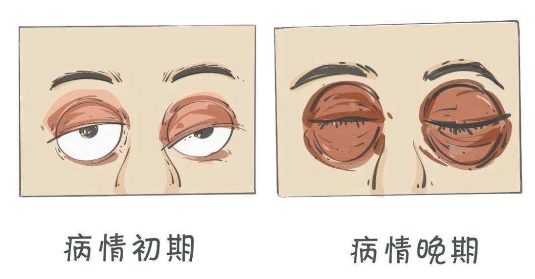 什么是水肿眼 fbfb0ce5eed94648b503d420eceaf6dc.jpeg