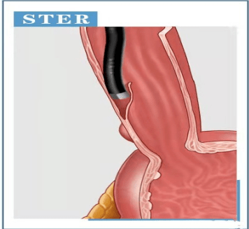 肿瘤|食管壁内“挖土豆” 肿瘤切除不留痕