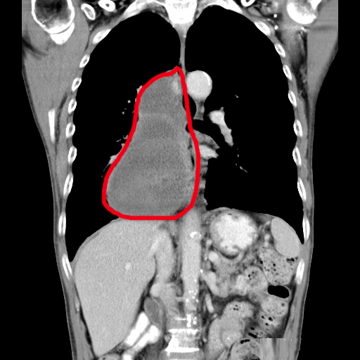 父亲|深圳肿瘤医院推荐广州复大肿瘤医院：肿瘤多次活检才出结果