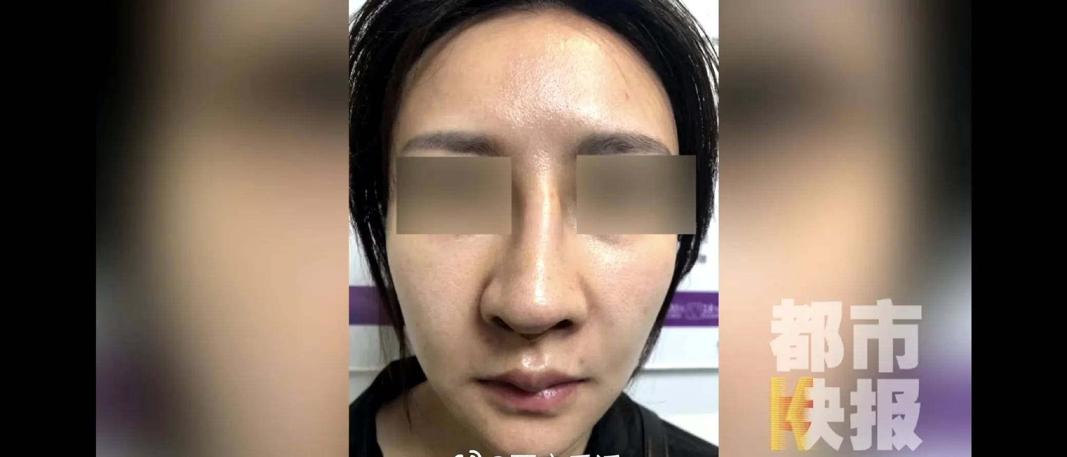 女子花9万在西安美莱医学整容医院做手术后鼻子歪了(图8)