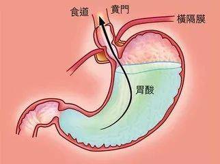 胃酸|寧波博仕腸胃病醫院：胃酸逆流有什么辦法可以阻止