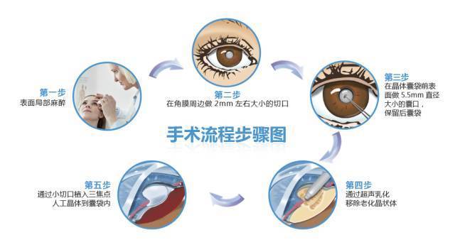 什么方法治老花眼 02c3e8a6a7de4946aa2818588b657272.jpeg