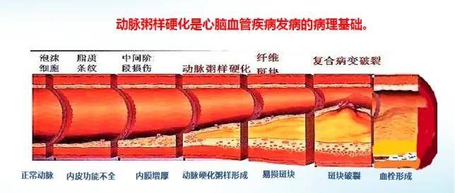 頸動脈imt升高是動脈粥樣斑塊形成早期階段的典型特徵,其數值越高,則