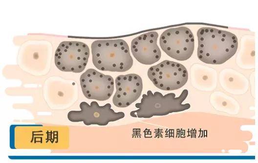 治疗|如何祛除烦人的黄褐斑？