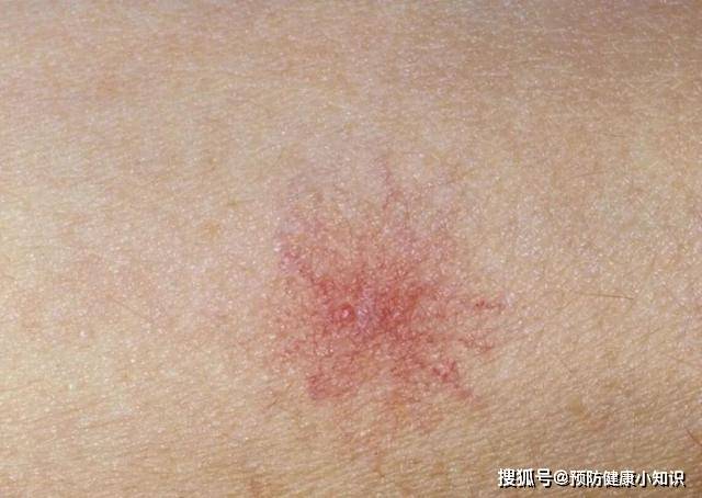 毒素|肝不好的人，每天坚持做这3件事，肝脏或许会给你点赞