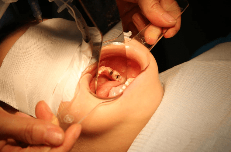 3岁童18颗蛀牙 口腔科专家提醒:防龋治龋 从娃娃抓起