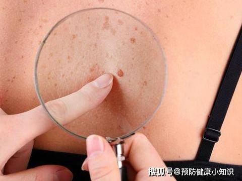 症状|实不相瞒！身体出现4个表现，或是肝硬化前兆，早治疗早好