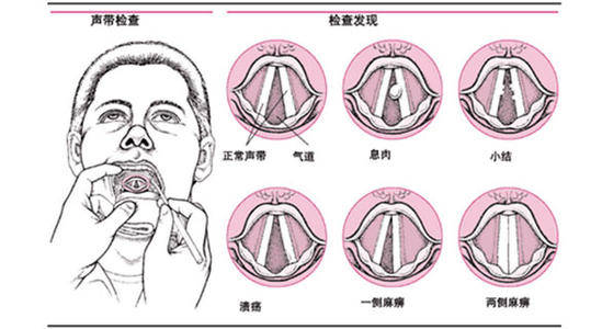 暨南大学崇爱医院耳鼻喉专科袁光明医师讲解声带息肉的症状