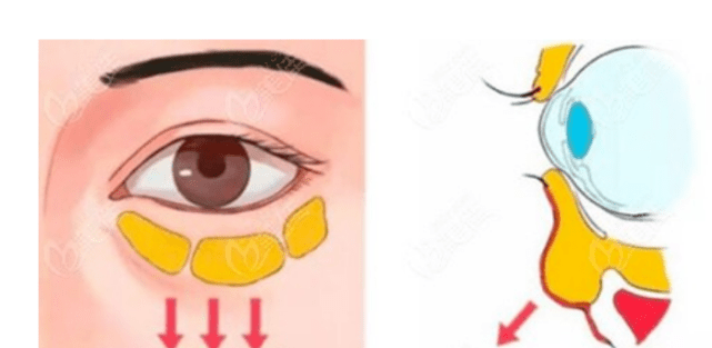 眼袋|蛋白线埋线去眼袋图片？吓人！
