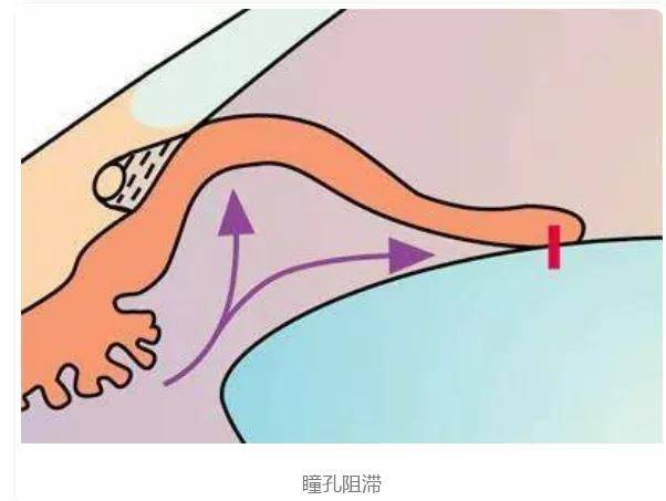 激光|激光周边虹膜切除术