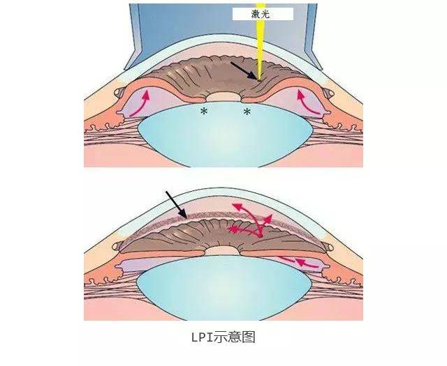 激光|激光周边虹膜切除术