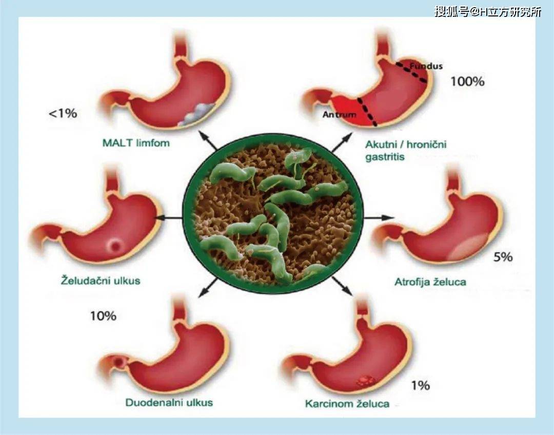 感染50中国成人的幽门螺杆菌致癌吗如何判断和检测