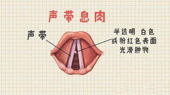 感冒,急慢性喉炎时声带已有不同程度 充血 , 水肿 再加上发声时声带