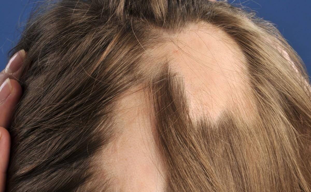 斑秃是一种头发呈斑片状脱落的皮肤病,患者一般没有任何感觉,有些患者