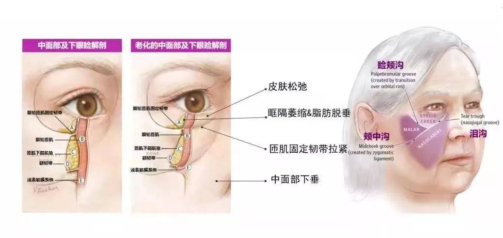 玛吉磨皮滤镜都去不掉的泪沟，还有救么？