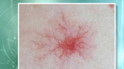 肝脏|有肝硬化的人，身体若没有这3个“症状”，恭喜，肝脏可能在好转