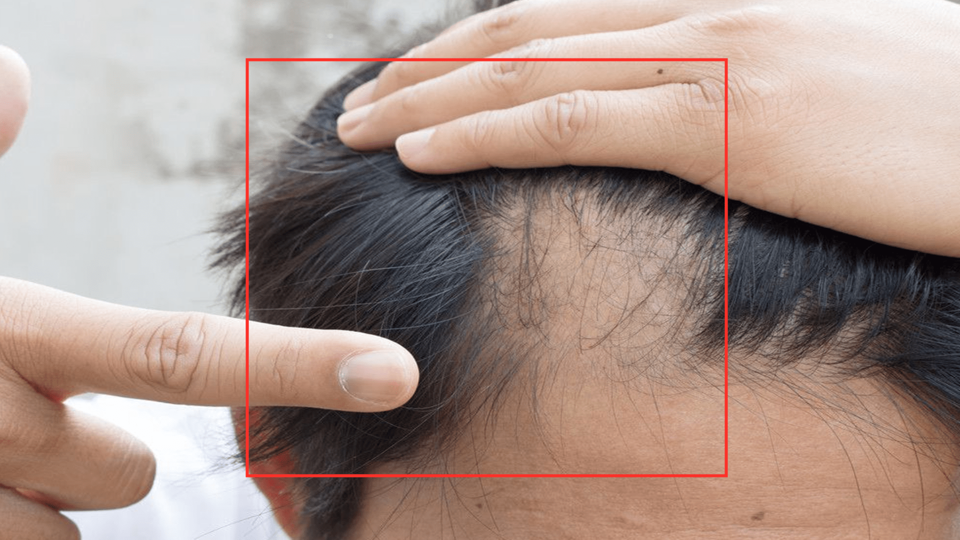 头发|每天掉超过100根头发是脱发？脱发5大元凶，少碰为妙