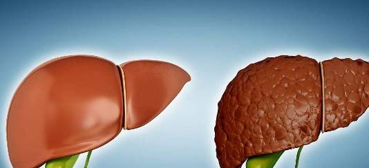 肝脏|有肝硬化的人，身体若没有这3个“症状”，恭喜，肝脏可能在好转