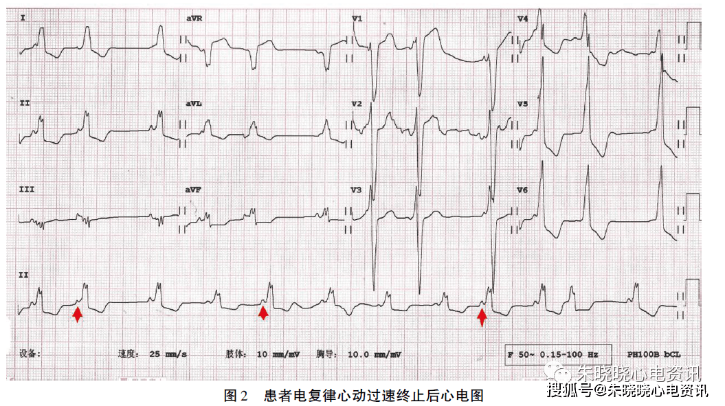 旁路|节律不齐宽QRS心动过速临床心电图分析