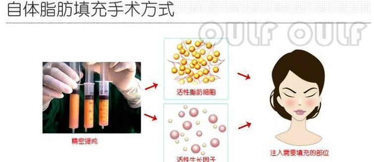 SVF-gel脂肪胶全脸填充要多少钱，要3万块钱是不是有点贵!