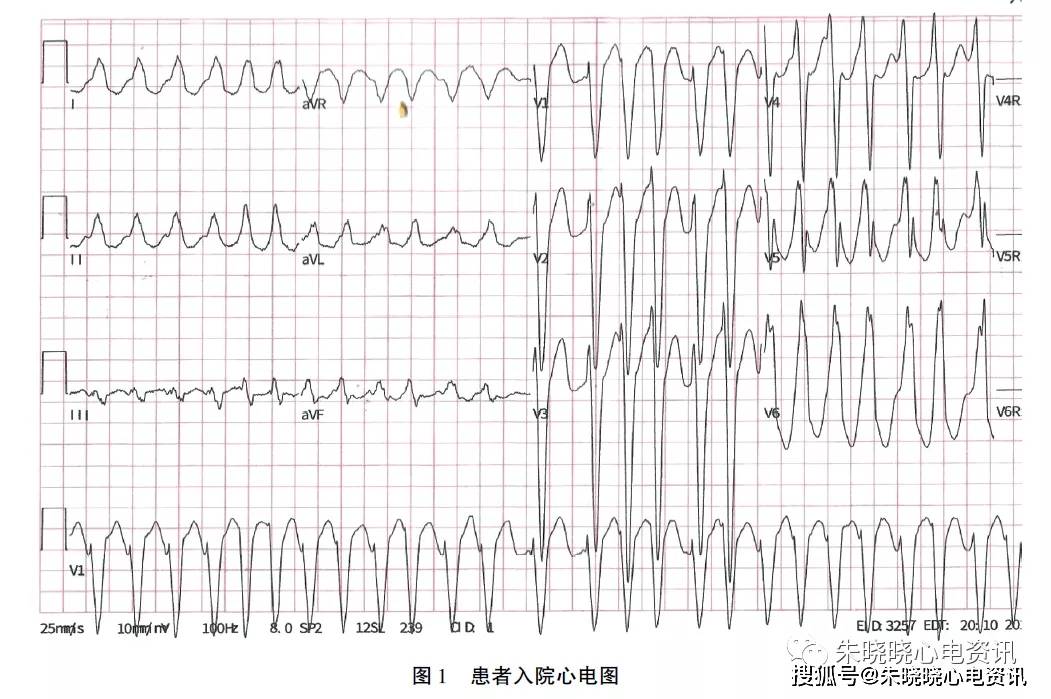 旁路|节律不齐宽QRS心动过速临床心电图分析