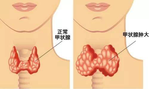 昆明中研甲狀腺醫院:甲狀腺囊腫不是良性結節嗎,為什麼說它可怕?_症狀