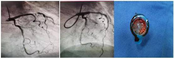成功|有介入无植入：北京老年医院心内科成功实施冠脉内血栓抽吸术救治急性心梗患者