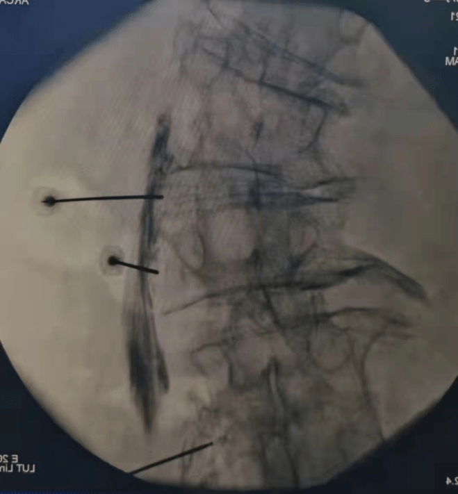 手术|腰疼40年，腰椎侧弯70度，不开刀能治好吗？