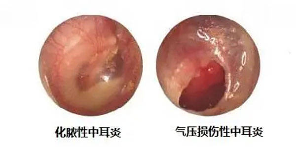 民生|成都民生耳鼻喉医院治耳痛耳流脓效果 专治耳鼻喉