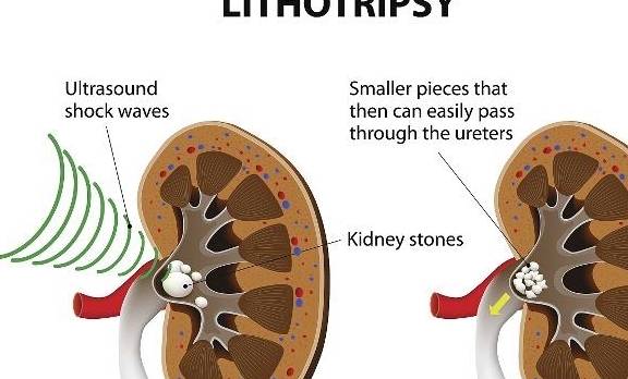 治疗|肾脏被“结石”占领，可能会有2个危害，别忍忍就算了