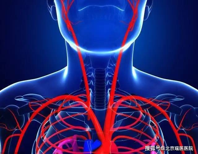 【沉默杀手】人过三十五,就怕血管堵,颈动脉狭窄年轻化,不容小觑