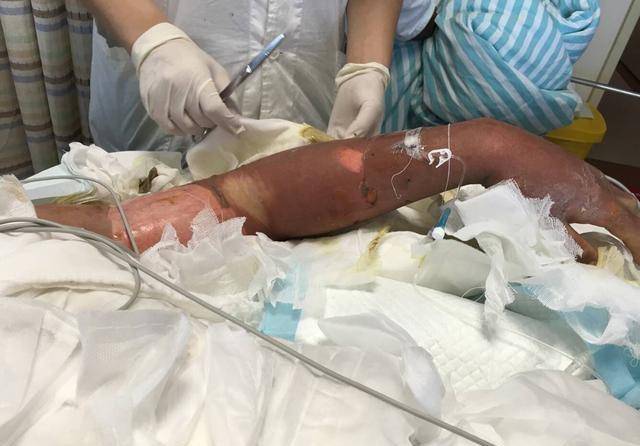 症状|你知道''尿毒症''吗？日常生活中我们应注意什么，本文或为您解答