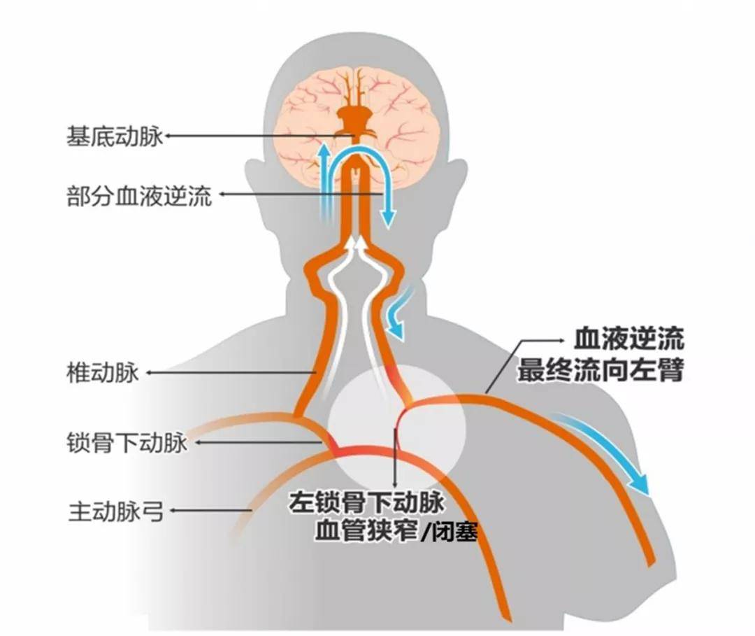 技术|北京老年医院成功完成经桡动脉入路慢性锁骨下动脉闭塞再通术