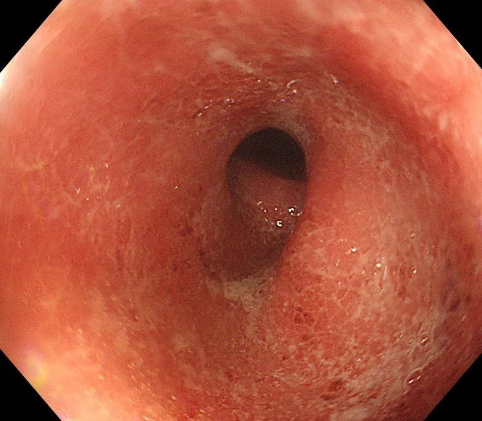 航天城|危言耸听？溃疡性结肠炎活不过10年！