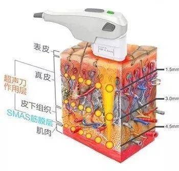 治疗95后都有颈纹了，“祖传颈纹”还有救吗？