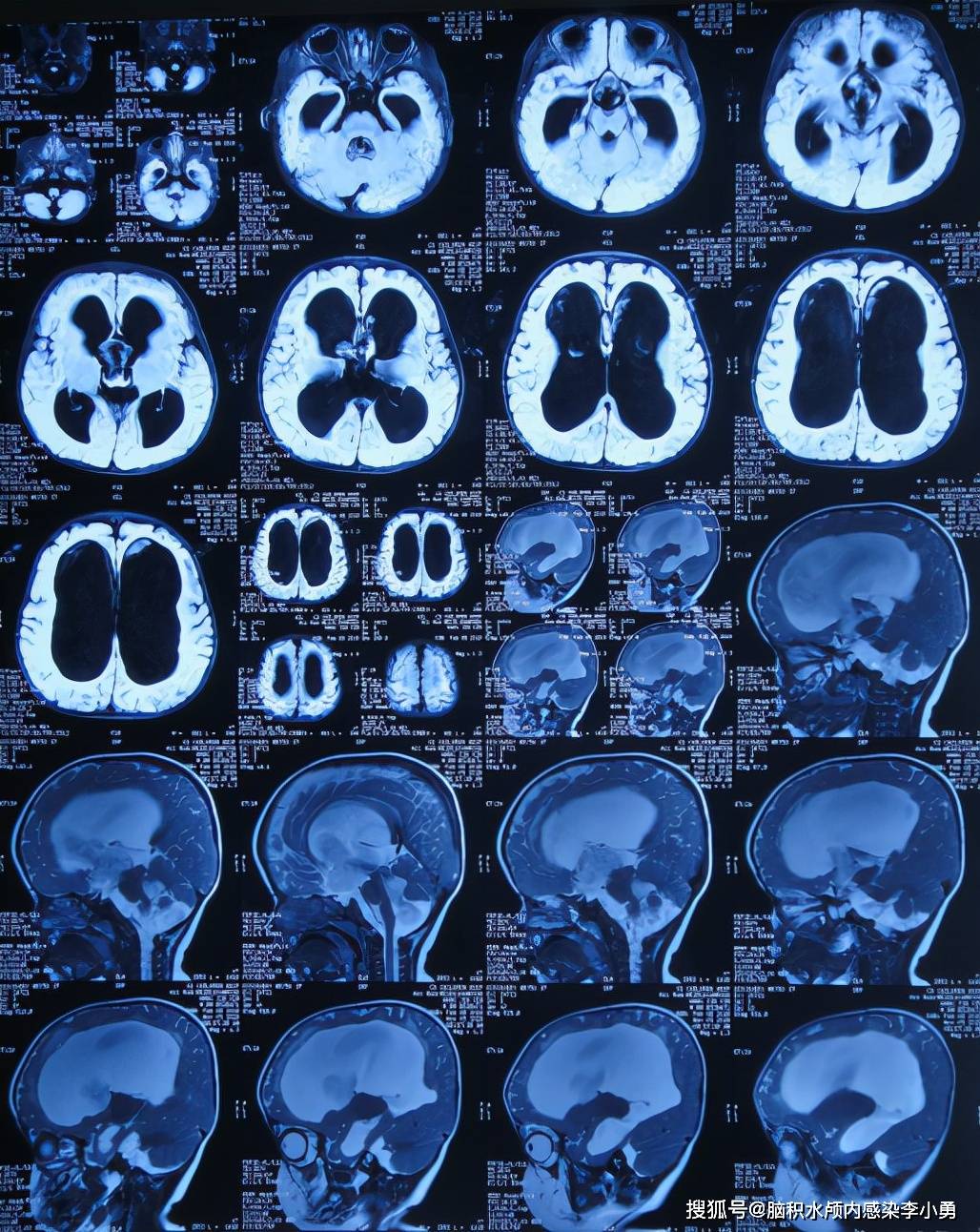 9個月大嬰兒查出腦積水後 及時治療現在近3歲身體智力一切正常_頭顱