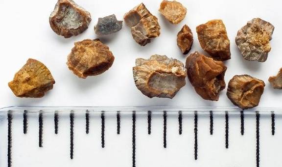 尿酸|肾结石是怎么形成的？劝告：这5类食物，别再贪嘴多吃