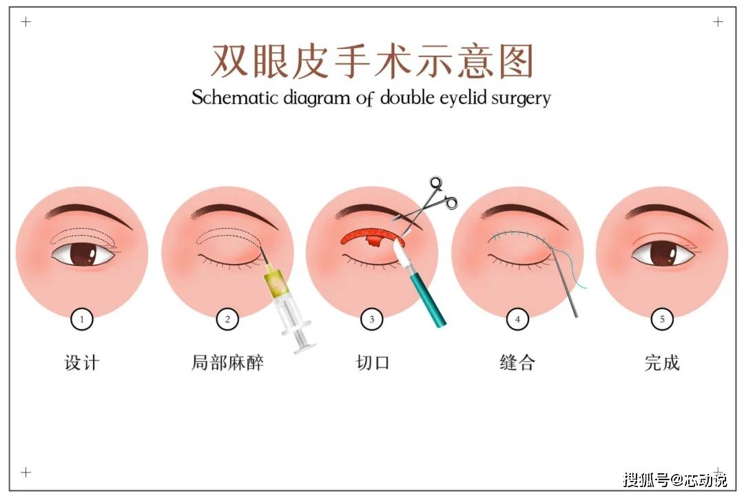 单眼皮双眼皮没割好？到底该咋修复？