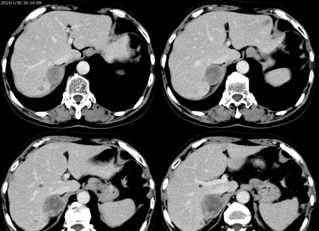 诊治|限制性心肌病,心肌病中最罕见的类型,其诊治手段有哪些呢?