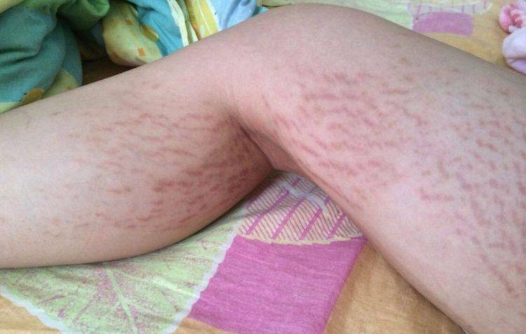 原创有的孕妈生娃后没有妊娠纹,如何做到的?孕期做好3点你也可以