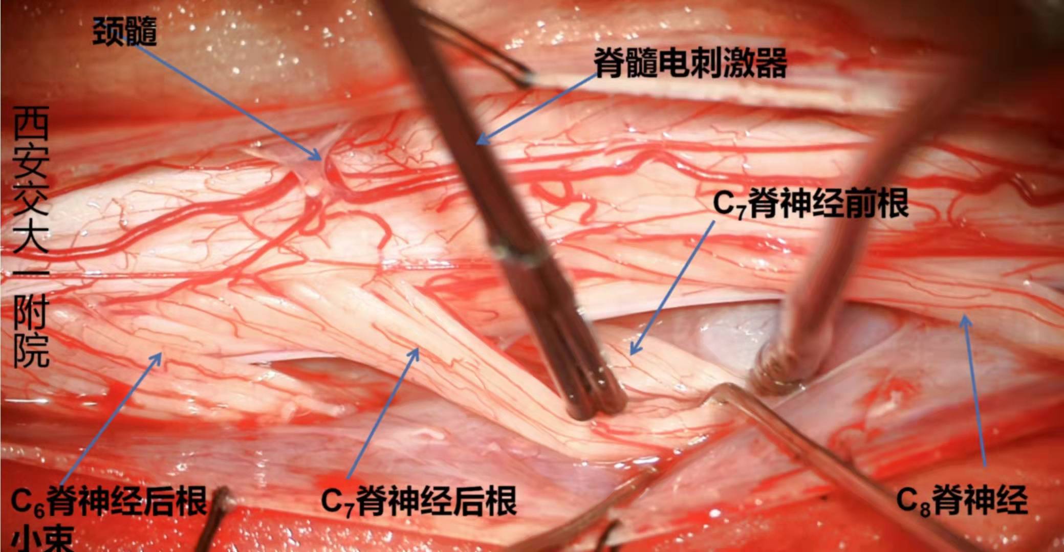 西安交大一附院神经外科完成西部首例颈段选择性脊神经后根部分切断术