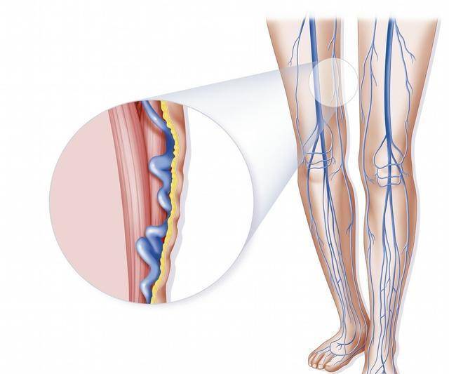 控制|一位糖尿病患者说，在脚上发现了一块黑斑，以后会不会截肢？