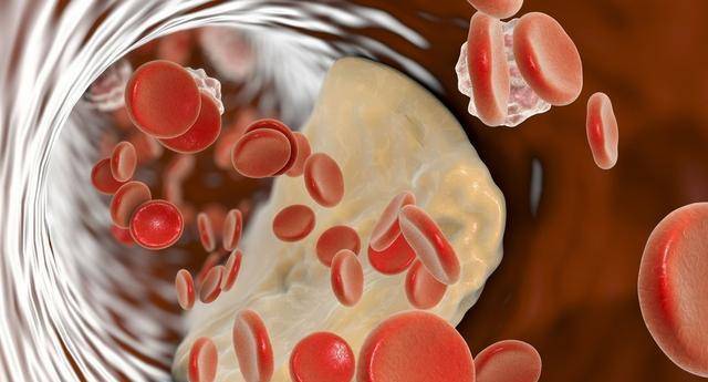 治疗|患了脑梗之后，一直在吃“他汀”，血脂正常了能不能停？