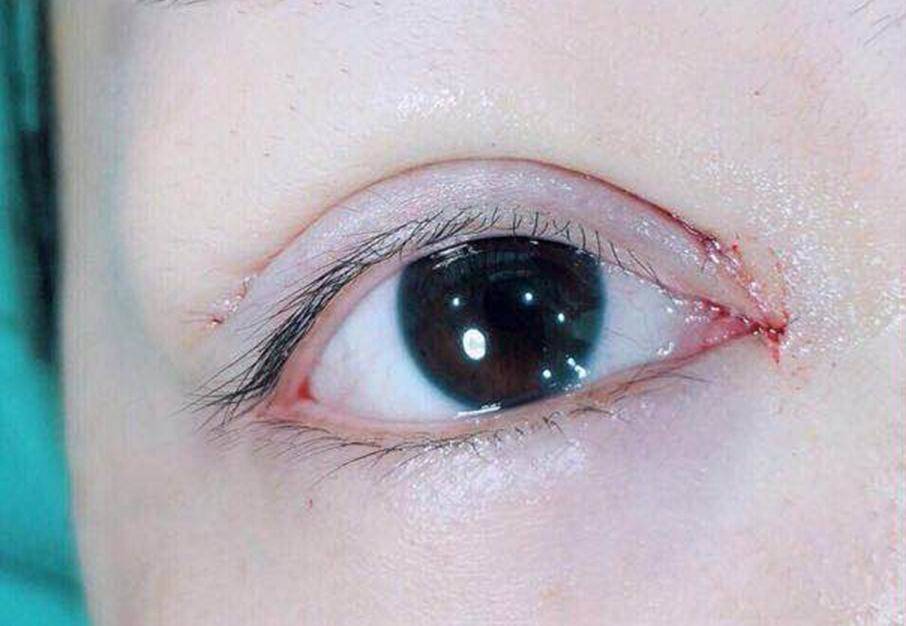 确切的重睑线很重要,调整了眼型更加传神!