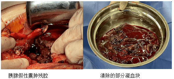 医学科|女子腹痛拖了俩月，引发大出血，危及生命