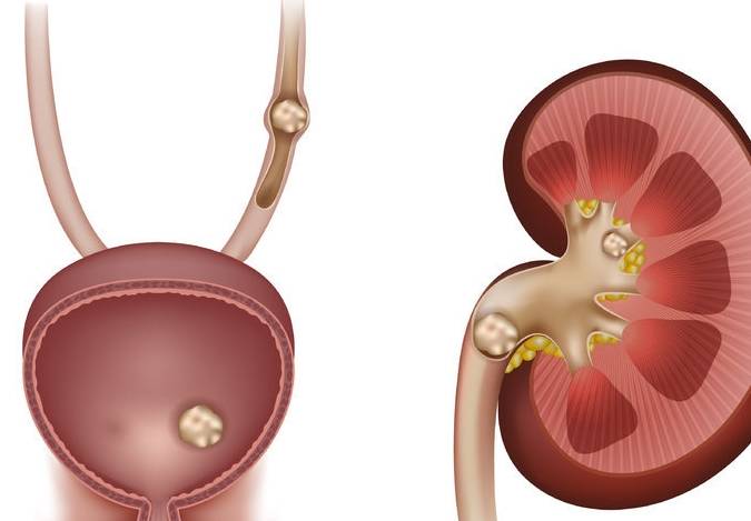尿酸|患上肾结石怎么办?医生:牢记3个禁忌,有效避免结石长大